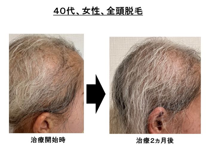 円形脱毛症　病院